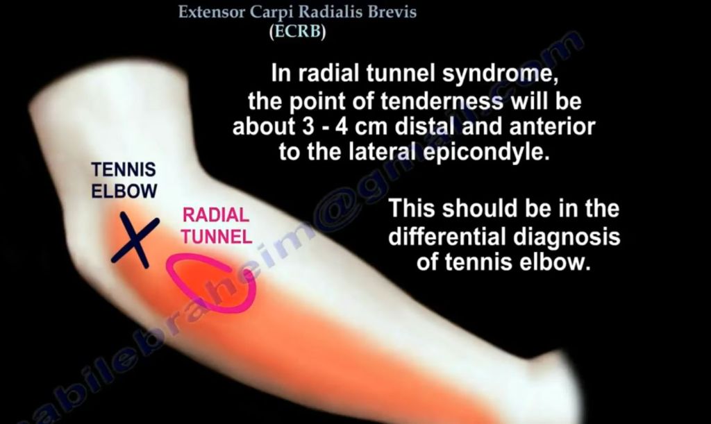 radial-tunnel-syndrome.jpg